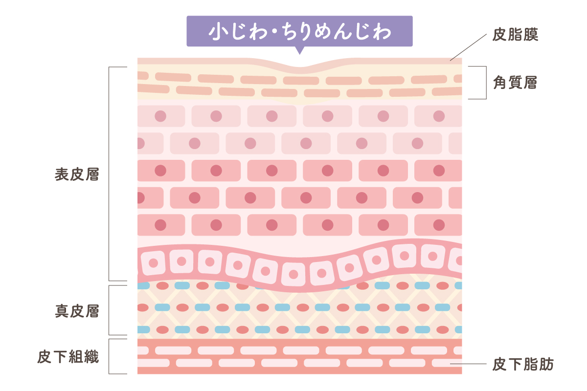 小じわ・ちりめんじわの状態を示した肌断面のイラストです。表皮層から真皮層、皮下組織までの構造が描かれており、角質層や皮脂膜の乱れによって肌表面がなめらかでなくなっている様子を、やさしい色合いでわかりやすく表現しています。