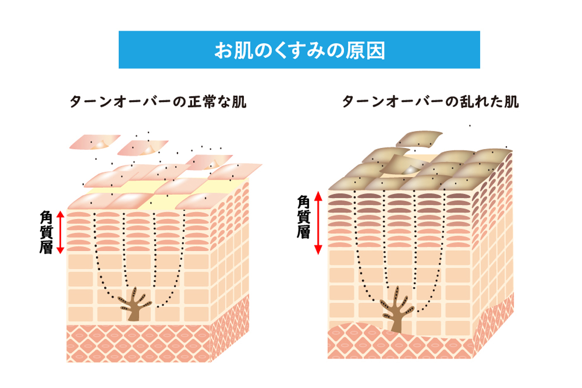 肌のくすみの原因を、ターンオーバーの正常な肌と乱れた肌で角質層の厚さが変化することを示したイラスト。ターンオーバーの乱れた肌では角質が積み重なってくすみを引き起こしている。