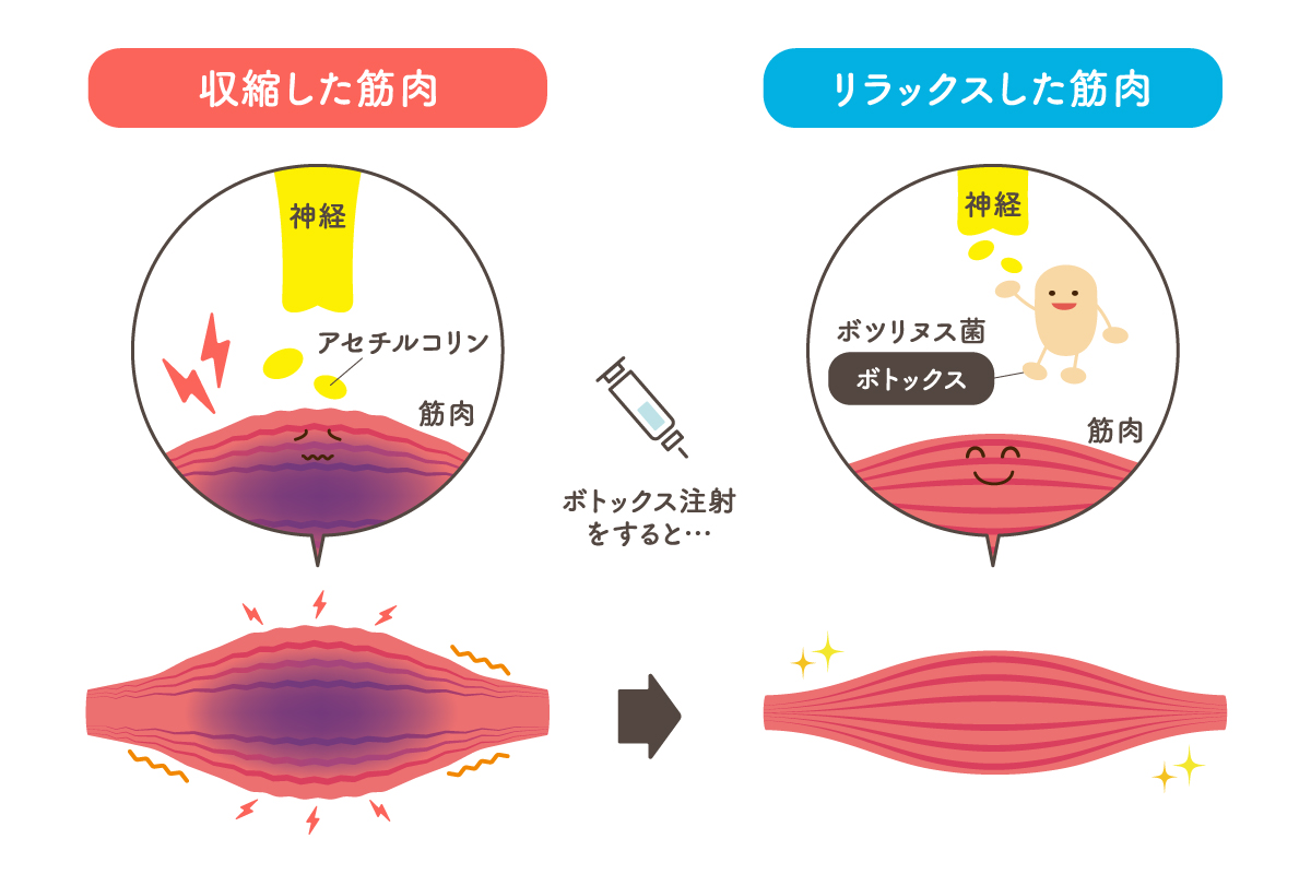 ボトックス注射による筋肉の変化を「収縮した状態の筋肉」と「リラックスした状態の筋肉」で表したイラスト。神経からの伝達物質であるアセチルコリンをボツリヌス菌がブロックすることで筋肉がリラックスする様子が描かれている。