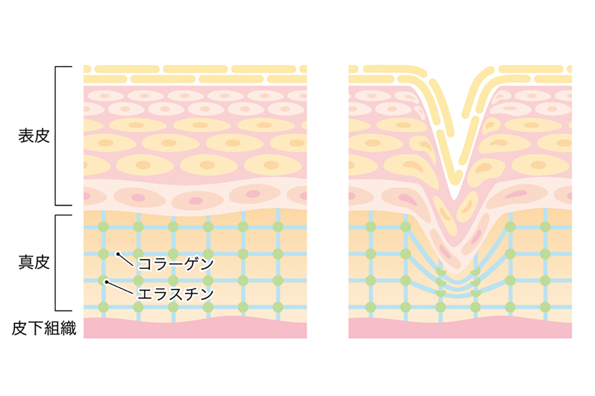 皮膚の断面図でコラーゲンとエラスチンの構造が崩れ皮膚にシワができている様子を示したイラスト。上から順に表皮・真皮・皮下組織と続き、真皮にコラーゲンやエラスチンが格子状に連なっている。