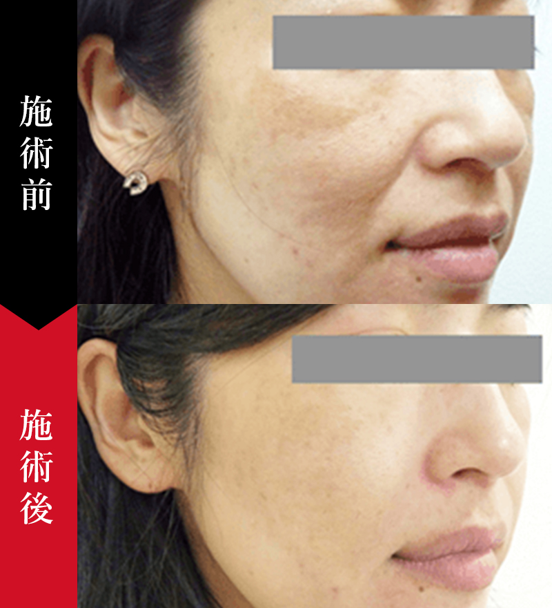 肝斑や顔のくすみに対するレーザートーニング治療の症例写真。50代女性の横顔。