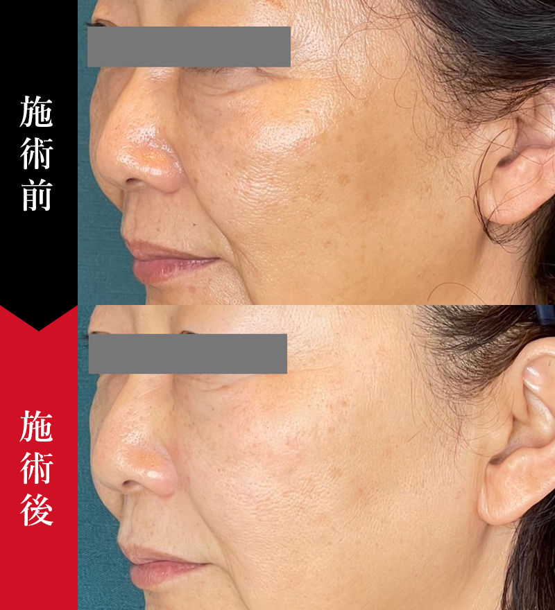 肝斑に対するレーザートーニング治療の症例写真。50代女性の横顔。