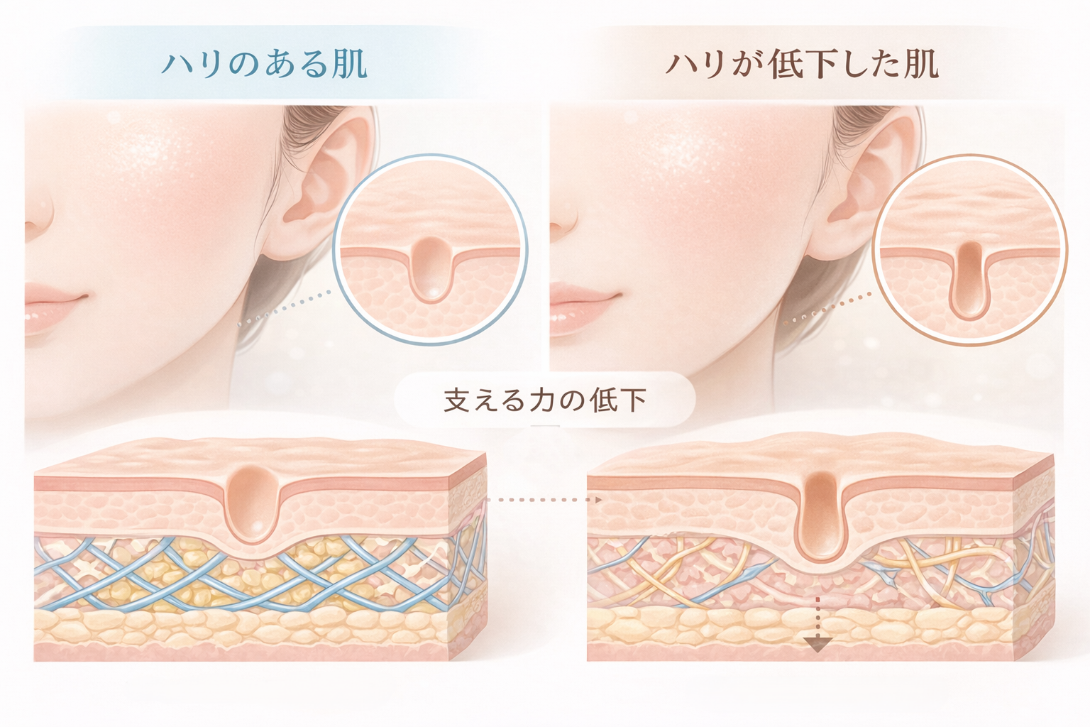 ハリのある肌と、年齢とともにハリが低下して毛穴が縦に広がって見える肌を比較した断面イラスト。