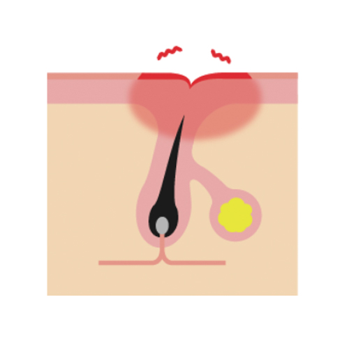 赤みタイプのニキビ跡を肌の断面から見たイラスト