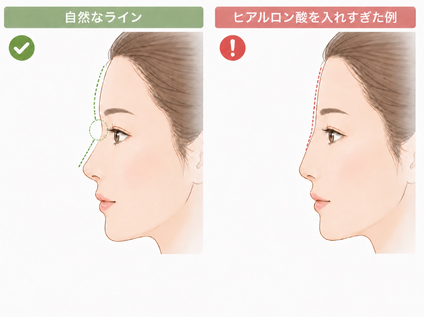 左右に女性の横顔イラストが並び、左は「自然なライン」としておでこから鼻筋へのなめらかな曲線が緑の点線で示されている。右は「ヒアルロン酸を入れすぎた例」として、おでこから鼻筋にかけて直線的になった状態が赤い点線で示されている。