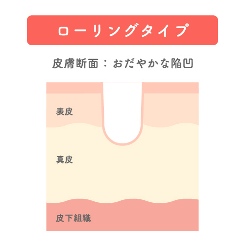 肌のクレータータイプを表した肌断面のイラスト。ローリングタイプで真皮層にまでへこみが到達している。