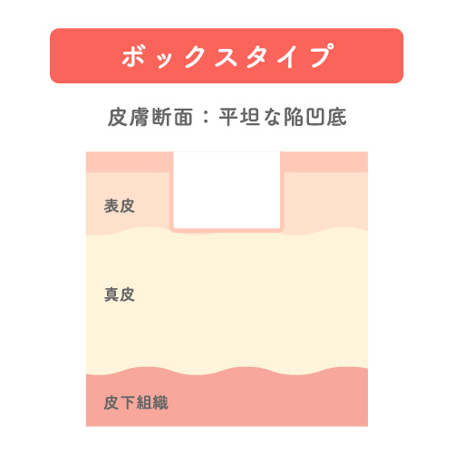 肌のクレータータイプを表した肌断面のイラスト。ボックスタイプで表皮深層にまでへこみが到達している。