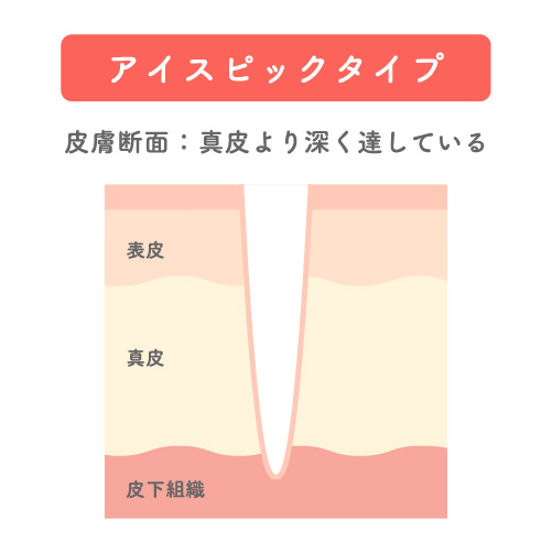 肌のクレータータイプを表した肌断面のイラスト。アイスピックタイプで皮下組織にまでへこみが到達している。