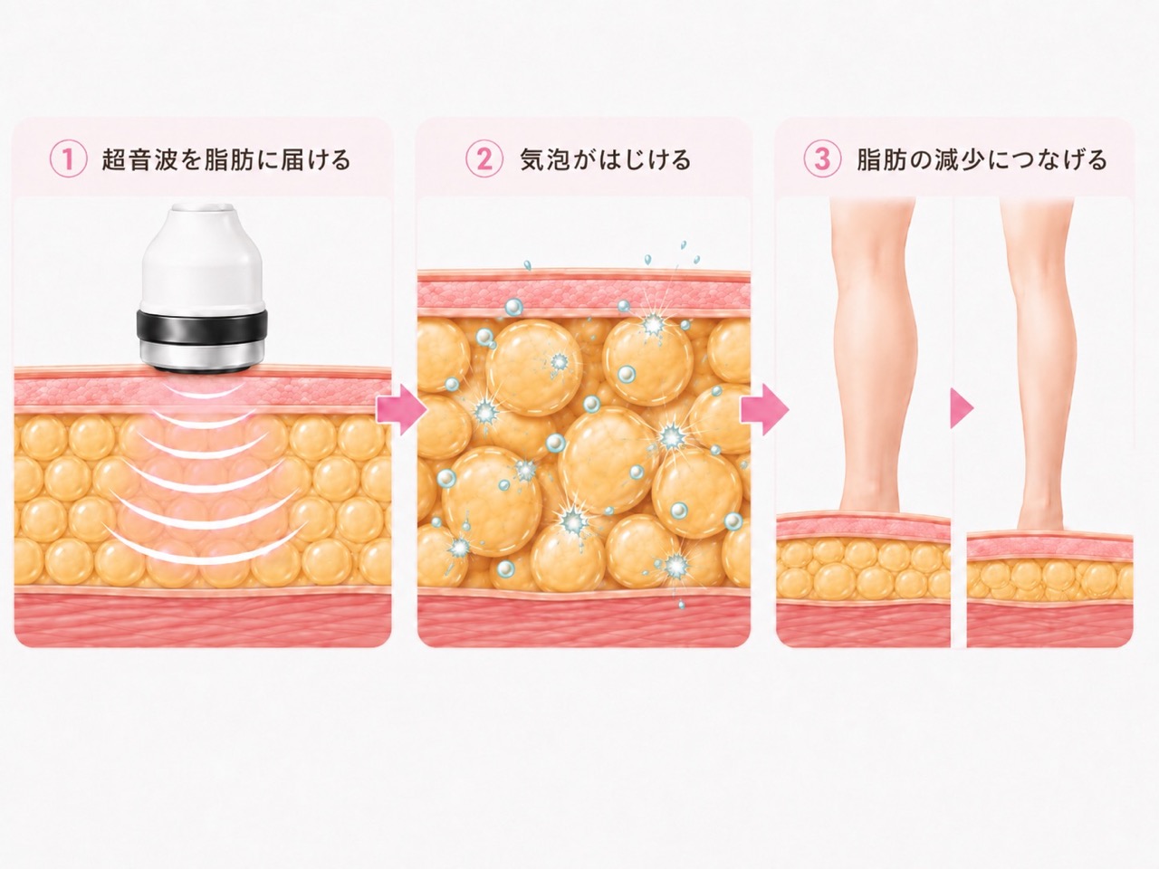 キャビテーションの仕組みを3段階で示した図。超音波が脂肪層に届き、気泡がはじけて脂肪細胞に働きかけ、施術前後で脂肪の厚みが減る様子をイラストで表している。
