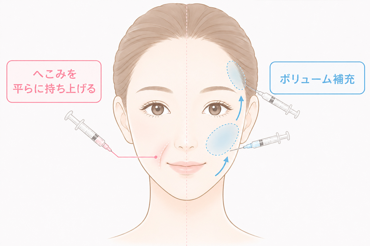 ほうれい線のへこみを平らに持ち上げる注入と、こめかみや頬のボリューム補充によって顔全体のバランスを整える注入の違いを、1つの顔で左右比較した美容医療の図解イラスト。
