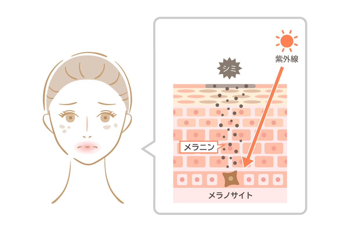 紫外線がメラノサイトを刺激し、シミの原因であるメラニンが生成される様子を描いた肌断面のイラスト。