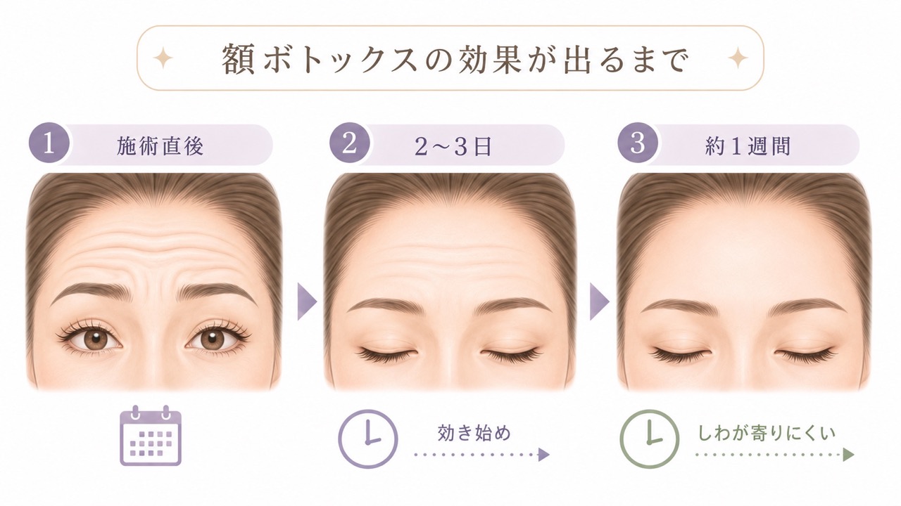 額ボトックスの効果が現れるまでの流れを、3つの段階で示したイラスト。施術直後は額にしわが見られ、2〜3日後には薬剤が効き始め、約1週間後には表情じわが寄りにくくなる様子。