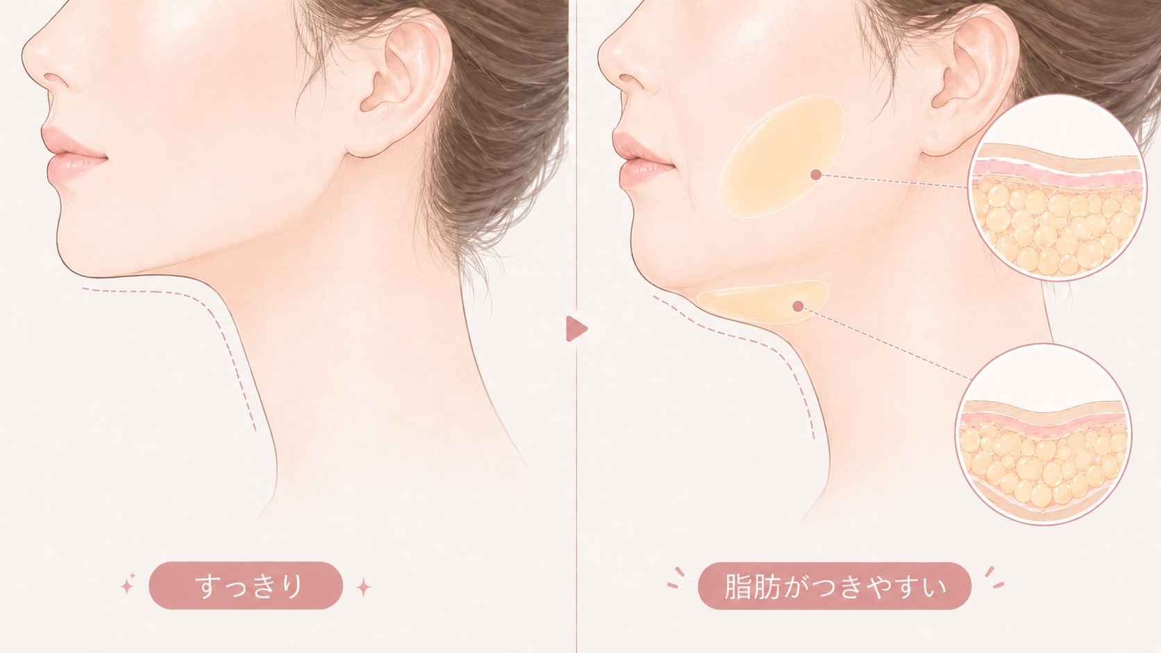 すっきりしたフェイスラインと、頬やあご下に脂肪がつきやすいフェイスラインを比較したイラスト。左側には輪郭がシャープな横顔が描かれ、右側には頬とフェイスラインのすぐ下に脂肪が強調された横顔と、脂肪の層を示す丸い断面図が添えられている。