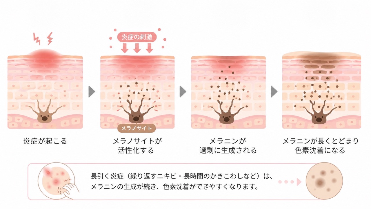 炎症後の色素沈着が起こる流れを示したイラスト。4つの肌断面図で、炎症が起こる、メラノサイトが活性化する、メラニンが過剰に生成される、メラニンが長くとどまり色素沈着になる、という過程が順番に描かれている。