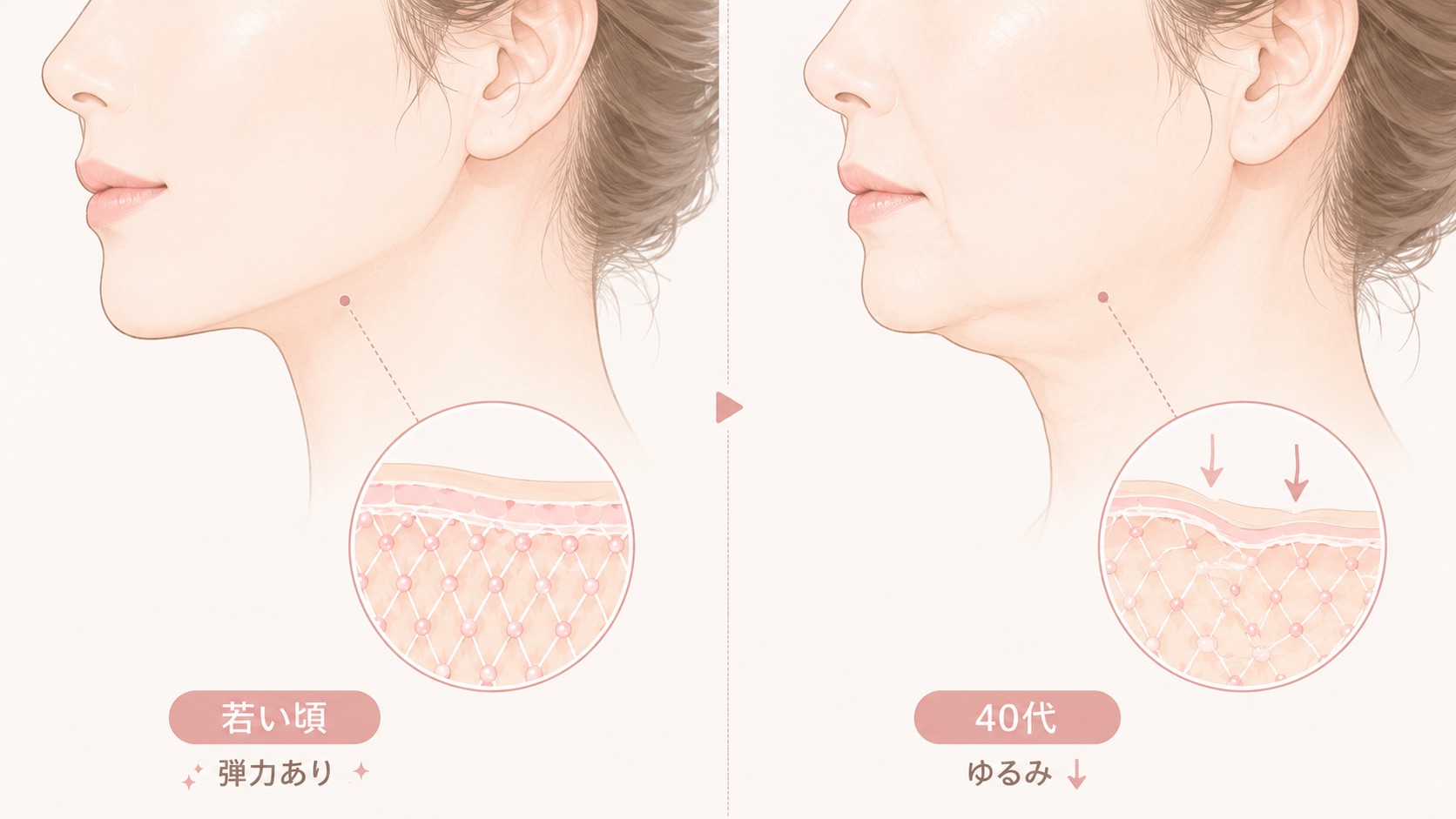 若い頃と40代のフェイスラインを比較したイラスト。左側には輪郭がすっきりした横顔と、弾力のある肌構造の図が描かれ、右側にはあご下や口元にゆるみが出た横顔と、支える力が弱まった肌構造の図が描かれている。