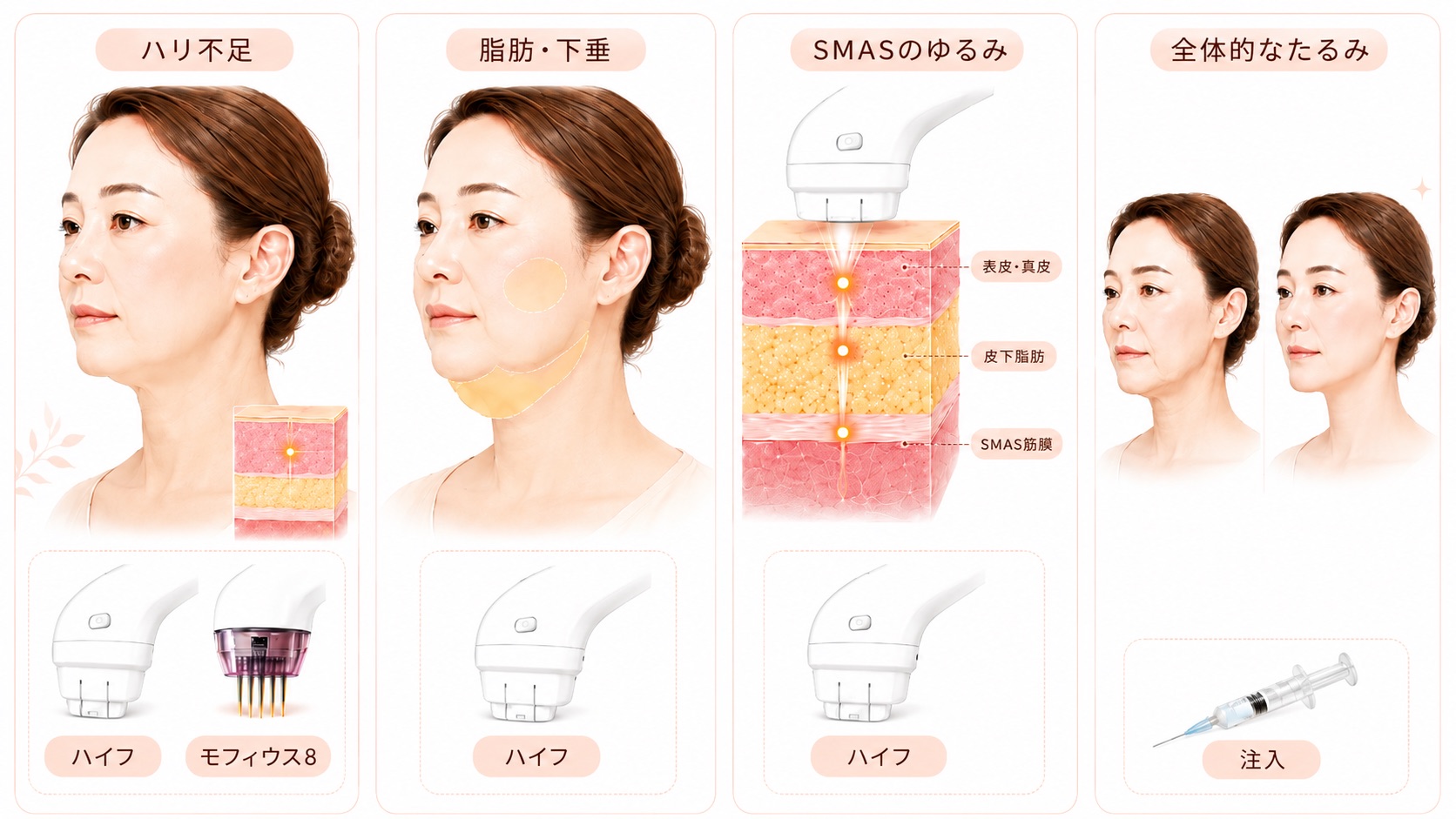 「ハリ不足」「脂肪・下垂」「SMASのゆるみ」「全体的なたるみ」の4つの原因別に、40代女性のフェイスラインの変化と適した施術を示した美容医療の比較イラスト。医療ハイフ、モフィウス8、注入治療の機器や皮膚断面図もあわせて描かれている。