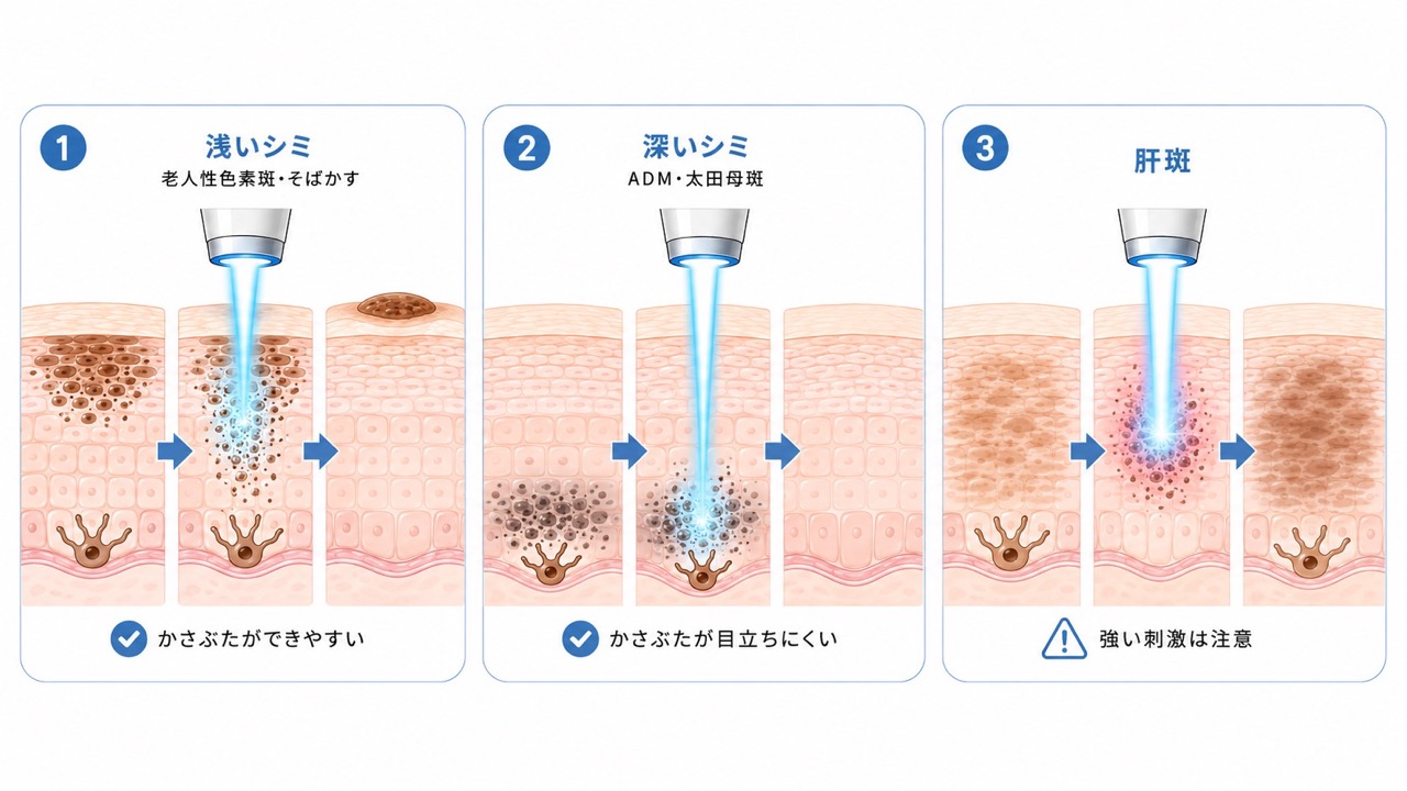 3つの図で、浅いシミ、深いシミ、肝斑それぞれに対するレーザー治療の違いを、皮膚断面のイラストで示した画像。浅いシミは表面近くの色素に反応してかさぶたができやすく、深いシミは皮膚の深い層に反応してかさぶたが目立ちにくく、肝斑は強い刺激に注意が必要であることを表している。