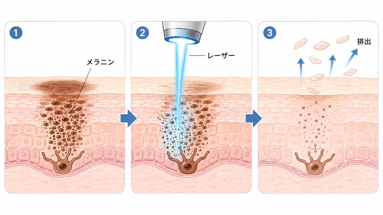 3つの図で、皮膚の断面にあるメラニンへレーザーが照射され、色素が細かく分解されて上方へ排出される流れを示した、シミ取りレーザー治療の仕組みを表すイラスト。
