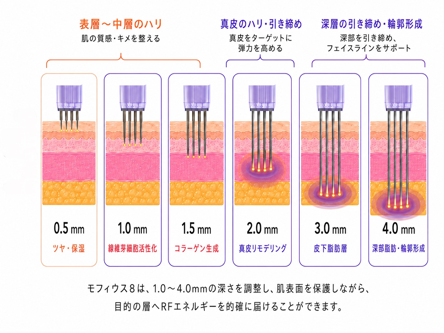 モフィウス8の作用深度を示した図。0.5mmから4.0mmまでの針の深さごとに、表皮〜皮下脂肪への到達範囲が描かれ、1.0〜4.0mmでは紫色の枠でモフィウス8が作用する深さが示されている。