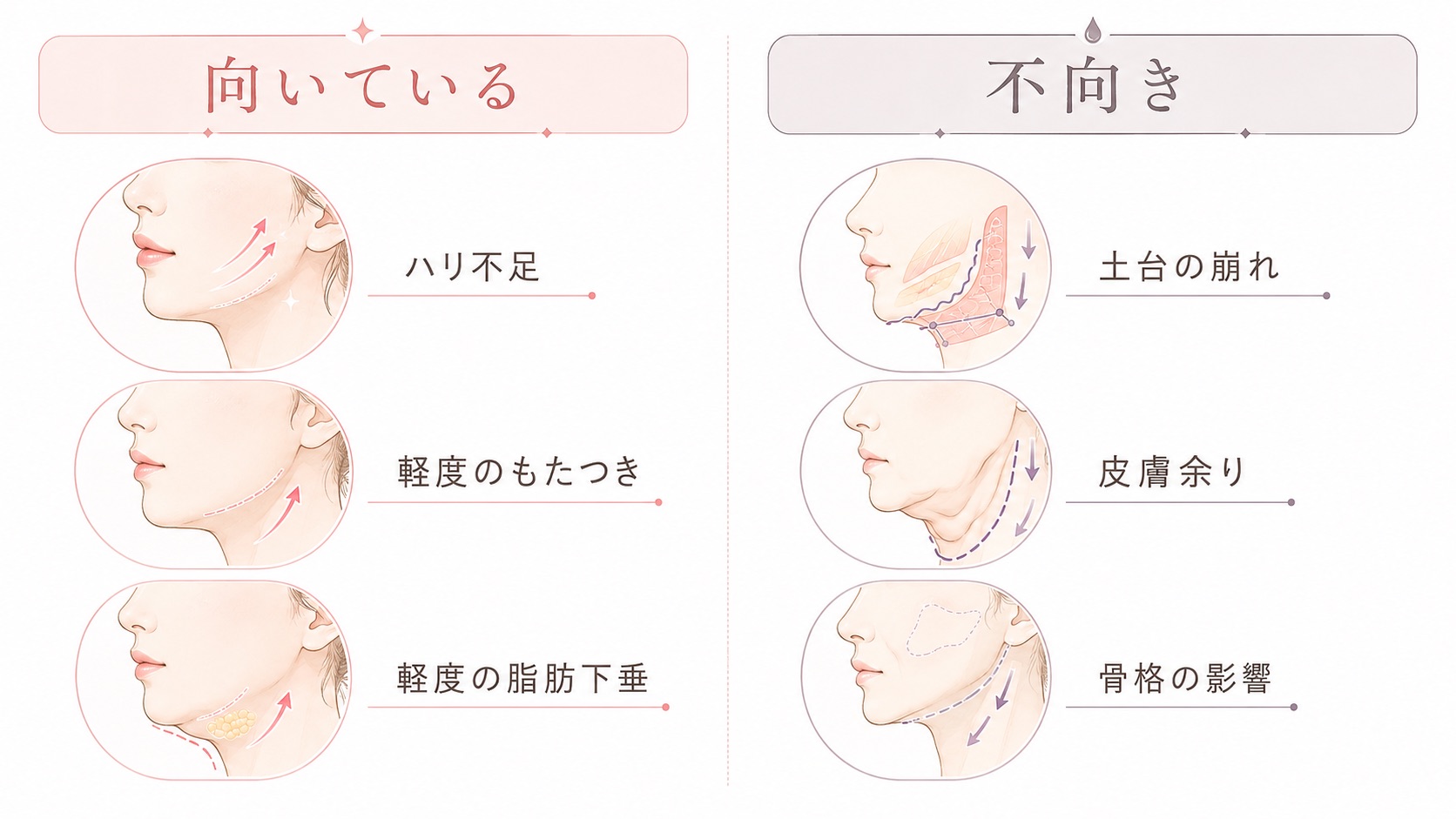 「向いている」と「不向き」に分かれた比較イラスト。左側には、肌のハリ不足、軽度のもたつき、軽度の脂肪下垂に当てはまるフェイスラインの例が並び、右側には、土台の崩れ、皮膚の余り、骨格の影響によるたるみの例が並んでいる。切らない美容医療が向いているたるみと不向きなたるみを比較して示した挿絵。