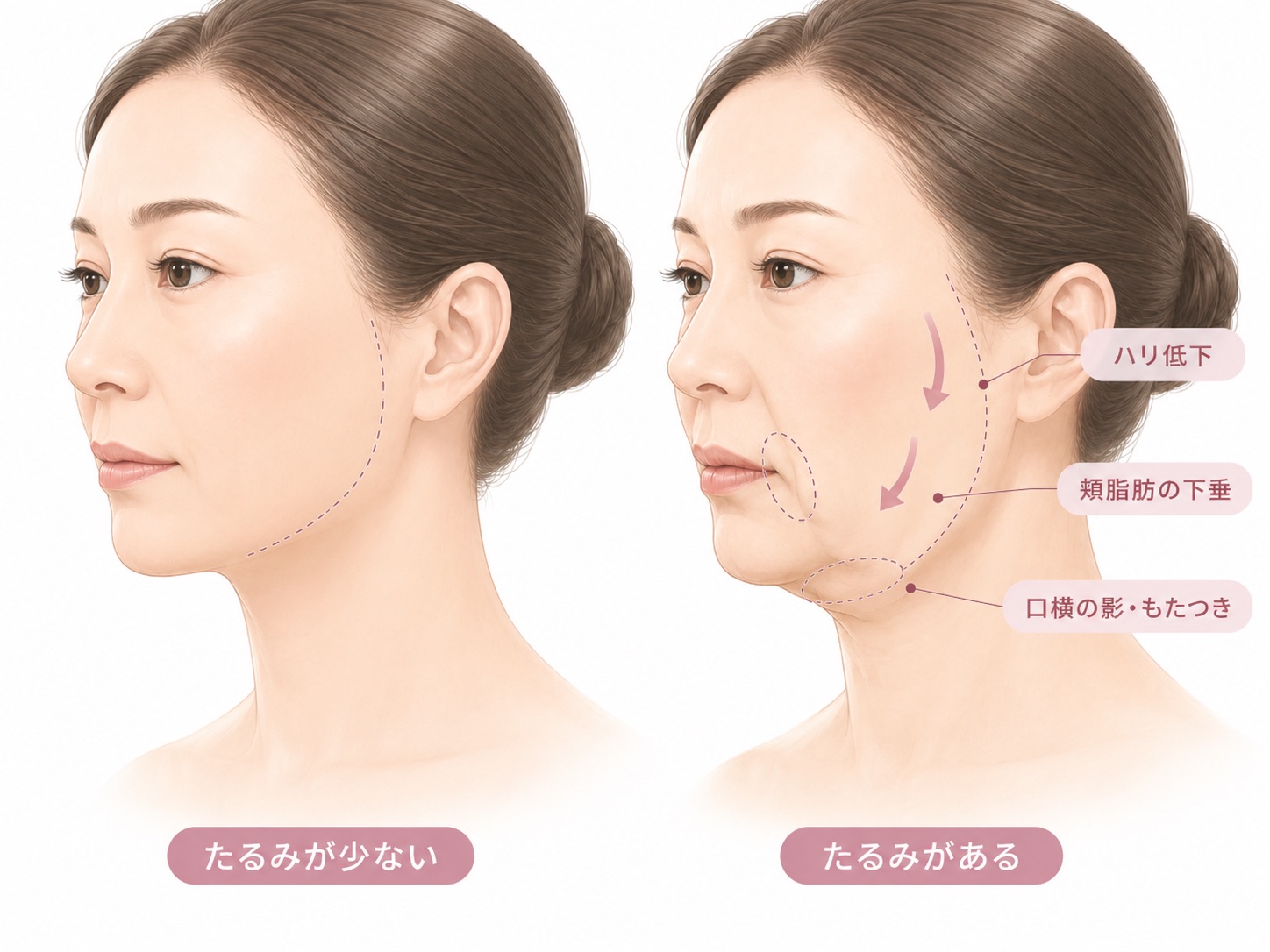 左側にたるみが少ない女性、右側にたるみがある女性を並べて比較したイラスト。右側の顔には、頬のハリ低下、頬脂肪の下垂、口横の影ともたつきが、矢印や囲み線で示されている。