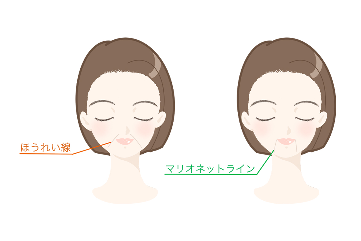 ほうれい線とマリオネットラインの位置を、女性の顔イラストと矢印で示した解説画像。口元のシワの種類や違いをわかりやすく説明している。