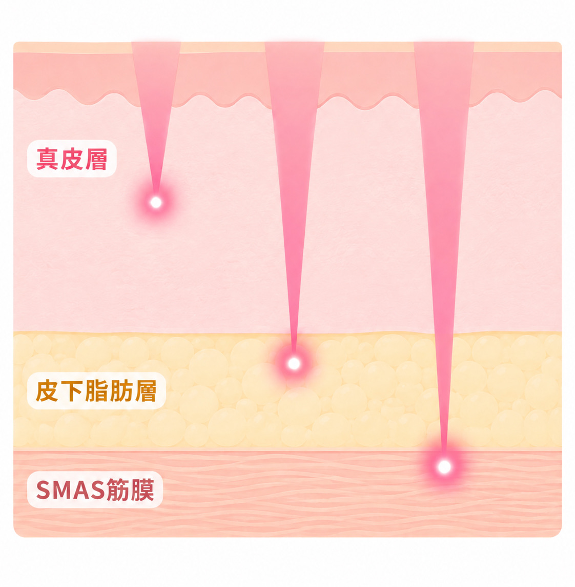 皮膚の断面に真皮層・皮下脂肪層・SMAS筋膜を示し、医療ハイフの熱がそれぞれ異なる深さへ点状に届く仕組みを、3本のピンク色の照射線と発光点で表したイラスト。