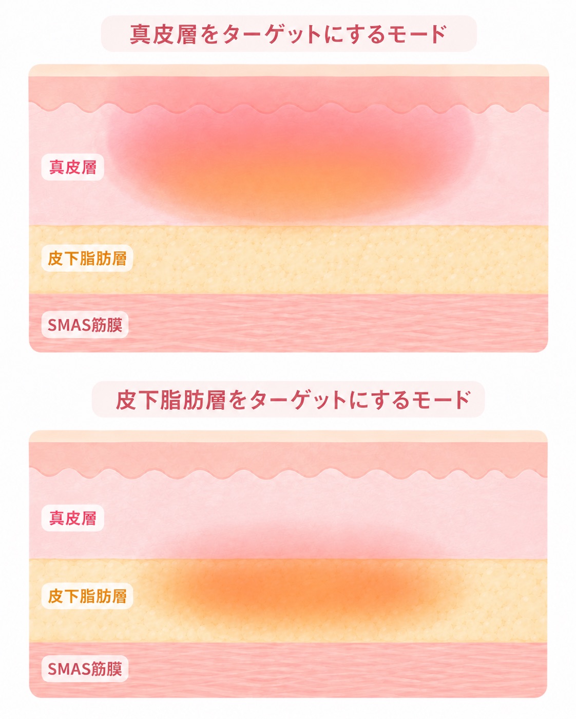 真皮層をターゲットにするモードと、皮下脂肪層をターゲットにするモードを上下2段で比較し、熱がそれぞれの層に広がる範囲を示したザーフのイラスト。