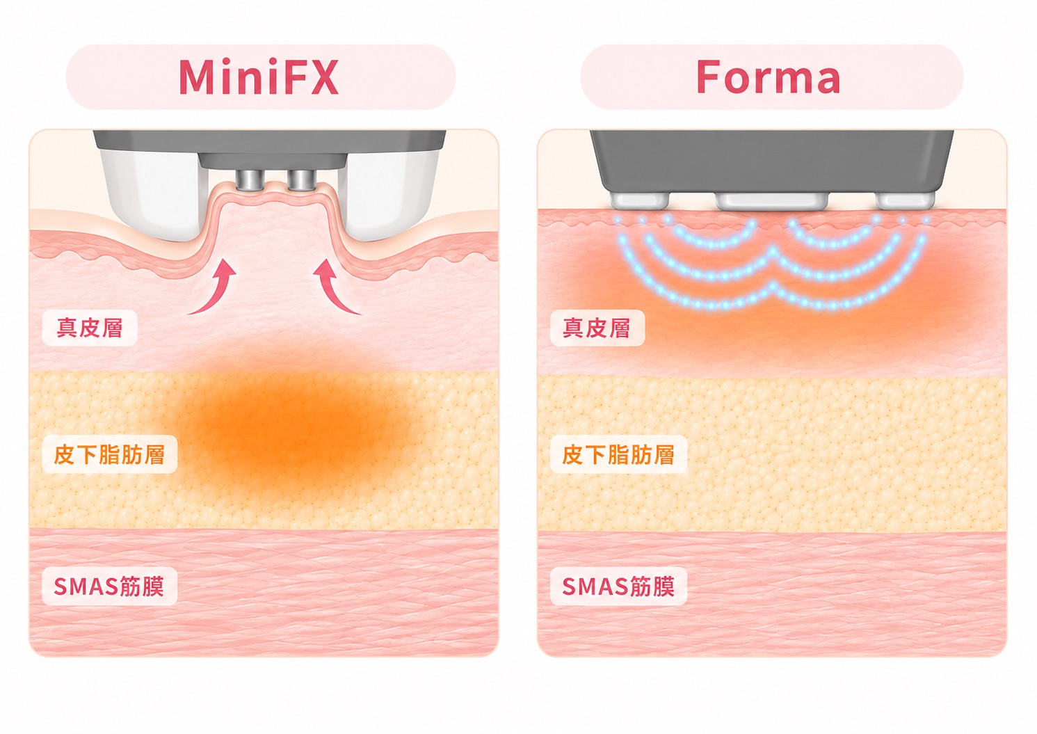 MiniFXとFormaの作用を左右で比較し、MiniFXは皮膚を吸引しながら皮下脂肪層へ高周波を届け、Formaは真皮層へ広く熱を加える仕組みを示したインモードVリフトのイラスト。