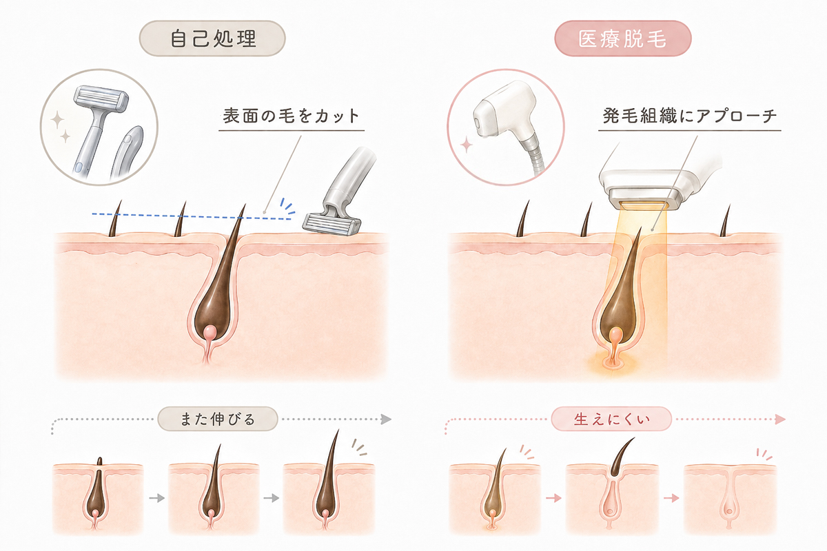自己処理と医療脱毛の違いを比較したイラスト。左はカミソリで肌表面の毛を切るため毛根は残り、時間がたつと再び毛が伸びる様子、右は医療脱毛で発毛に関わる組織へアプローチし、毛が抜けて生えにくくなる流れを、皮膚断面図と3コマでわかりやすく示している。